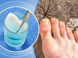 How To Use Hydrogen Peroxide For Nails Fungus Lifealth