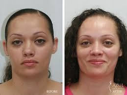 Rhinoplasty Nose Reshaping Surgery In Hyderabad Nose Plastic Surgery Plastic Surgery Nose Surgery