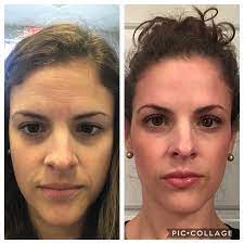 What is dysport and how does it work, exactly? Before And After Dysport Botox Crows Feet