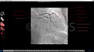 The main coronary arteries are: Anatomy Of The Coronary Arteries Anatomical Atlas On A Coronarograph