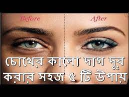 If you're looking for a lighter tan, this lotion is exactly what you need. Chokher Kalo Dag Dur Korun 5 Ti Upaye Get Rid Of The Dark Circles Under The Eyes For Lifetime Only 5 Youtube