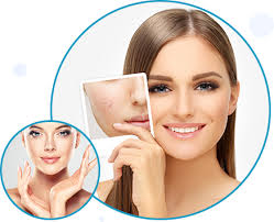 Acne Scar Removal Treatment Calgary