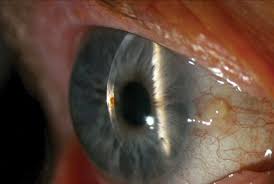 Image result for Eye Foreign Body