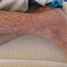 If purpura is caused by an infection, you may have a fever or pain in the infected body part. Palpable Purpura On Lower Legs Which Occurred 4 D After The Surgery Download Scientific Diagram