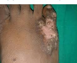 A18.47) is een ernstige vorm waarbij de infectie gedissemineerd is over de gehele huid (en in het gehele lichaam). Tuberculosis Verrucosa Cutis Case Report Of A Diagnostic Challenge Semantic Scholar