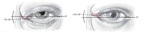 «endoscopic midface lift and cat eye surgery • cat eye surgery refers to several procedures that…» Canthoplasty Lifting The Corner Of The Eye 2pass Clinic