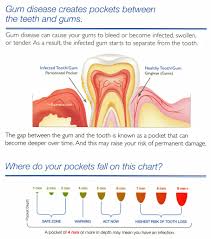 What Is A Periodontal Gum Chart Southfield Dentist