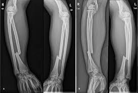 Image result for Galeazzi Sign