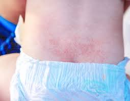 Image result for sweat rash on back baby