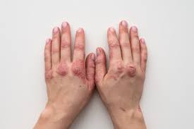 Psoríase em placas, psoríase invertida, psoríase em gotas, psoríase palmoplantar, psoríase pustulosa, psoríase eritrodemia e psoríase artropática. Psoriase Tratamento Para Psoriase Luciana Villas Boas