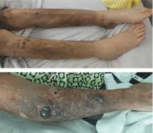 Chronic Kidney Disease Evolve Case Study