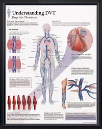 Understanding Dvt Chart 22x28 Vascular Ultrasound