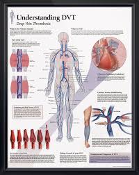 understanding dvt chart 22x28 vascular ultrasound