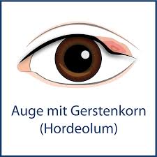 Wann muss man mit dem gerstenkorn zur fachärztin oder zum facharzt? Augenlid Erkrankungen Augenarzte In Berlin Am Platz Der Luftbrucke