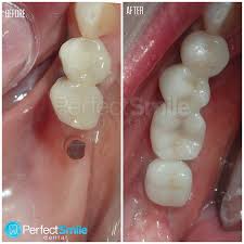 Routine dental treatments include tooth cleaning and polishing, tooth removals, gum surgeries, impaction or third molar removals,tooth colored fillings, root canal treatments and crown and bridge and teeth problems in children. Perfect Smile Dental In Tijuana Mexico Read 39 Reviews