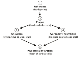 Heart Disease Flow Chart Myocardial Infarction Heart