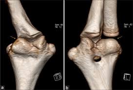 Image result for Radial Head Dislocation