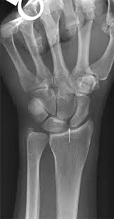Image result for Scapholunate Dislocation