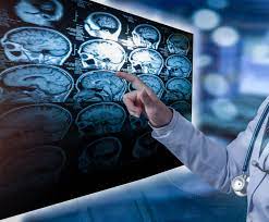 Este o afectiune cronica, inflamatorie a sistemului nervos central. Scleroza Multipla Afectiuni Si Conditii Clinica Neuroaxis
