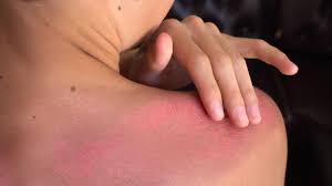 Try not to get sunburnt in the first place but if you do, have a cool shower, take painkillers and avoid alcohol. You Should Never Put Vaseline On A Sunburn Here S Why