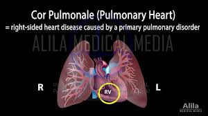 Image result for Cor Pulmonale