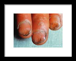 Image result for Koilonychia feet