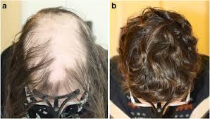Aphasia, a loss of the ability to speak and. Alopecia Areata A Comprehensive Review Of Pathogenesis And Management Springerlink