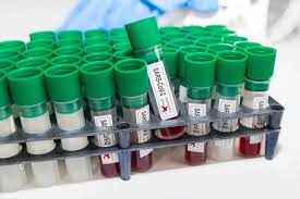 Jaka jest skuteczność prywatnych testów? Test Na Przeciwciala Na Koronawirusa Badanie Przeciwcial Anty Sars Cov 2