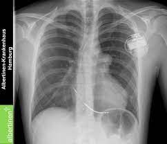 0212 986 06 50whatsapp i̇letişim: A Icd Pacemaker X Ray Doccheck