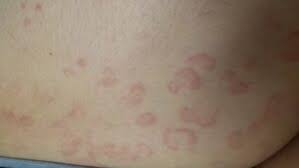 Image result for Erythema Multiforme Major