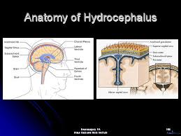 Nph Normal Pressure Hydrocephalus Hydrocephalus Vp Shunt Vp Dementia Shunt Programmable Shunt Ventriculoperitoneal Ventriculoperitoneal Shunt Houston Texas Katy Incontinence Fluid Brain Ventricle United States Gait Memory America Alzh