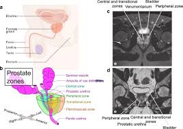 03.09.2021 · prostate cancer develops when the rates of cell division exceed those of cell death, leading to uncontrolled tumor growth. Clinical Proteomics For Prostate Cancer Understanding Prostate Cancer Pathology And Protein Biomarkers For Improved Disease Management Clinical Proteomics Full Text