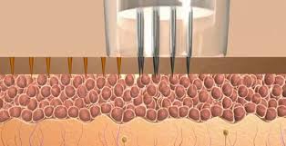 Ciraldo, since uneven skin texture typically goes. Micro Needling New Radiance Cosmetic Centers Palm Beach