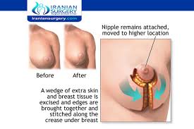 Find out about female breast reduction, including how much it costs, what to consider before deciding to have it, finding a suitably qualified surgeon, what the procedure involves, and what to do if things go wrong. How Long After Breast Reduction Will I Know My Size Review Video