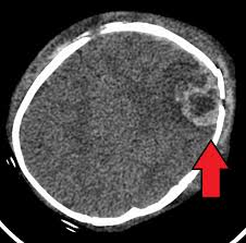 Shaken Baby Syndrome Wikipedia