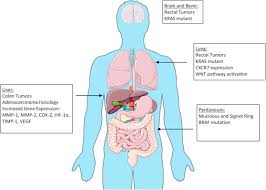 This means that the symptoms can be diagnosed when the disease is at an advanced stage. Surgical Treatment Of Metastatic Colorectal Cancer Surgical Oncology Clinics