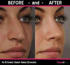 Russia 10th Most Popular Country For Surgery Tourism Surgery Before And After Rhinoplasty Cost Nose Surgery Nose Job