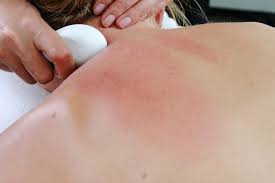 Gua sha masajı nasıl yapılır? Gua Sha Naturheilpraktiker
