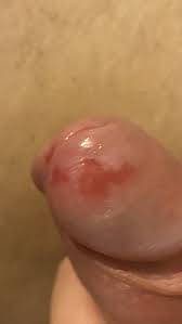 Пятна на головке полового члена На головке появились пятна , нет зуда |  MedAboutMe