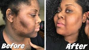What are the best creams for african americans who want lighter skin? How To Get Rid Dark Scars Hyperpigmentation Youtube