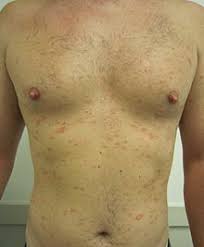 The condition has also been reported with numerous other potential etiologic agents. Pityriasis Rosea Wikipedia
