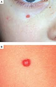 Image result for Spitz Nevus
