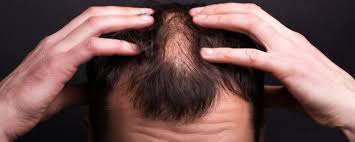 This fda approved drug is available in 2% or 5% formulas; Alopecia Areata Patchy Hair Loss Causes Symptoms And Homeopathic Remedies Schwabe Schwabe India