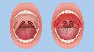 If it's tonsil stones, you'll usually either see hard, white lumps in craters in your throat, or holes. How Do You Know If You Have Tonsillitis Everyday Health