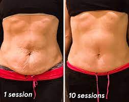 Body Sculpting Treatments In Allen | Body Sculpting Sessions