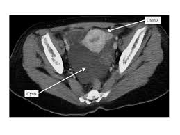 Multicystic peritoneal mesothelioma mcpm is a rare cystic proliferation most often seen in women of reproductive age with a history of prior abdominal surgery. Benign Multicystic Peritoneal Mesothelioma Mimicking Recurrence Of An Ovarian Borderline Tumor A Case Report Journal Of Medical Case Reports Full Text