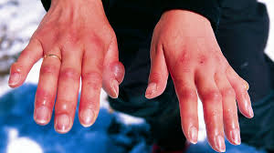 Ampoule au pied que faire pour la soigner et l eviter. Engelure Traitement Et Remedes De Grand Mere