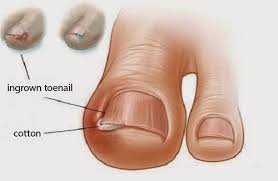 6 old remes for ingrown toenails