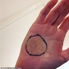 Under a fingernail or toenail; Mother S Itchy Birthmark That Lost Colour Turned Out Be Skin Cancer Sound Health And Lasting Wealth