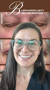 Say goodbye to stretched or oversized earlobes and hello to a more  balanced, natural look! ✂️✨ Earlobe reduction surgery is a quick, effective  solution to enhance your facial harmony and boost your